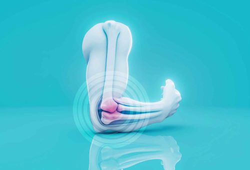 conceptual-3d-illustration-tennis-elbow-inflammation