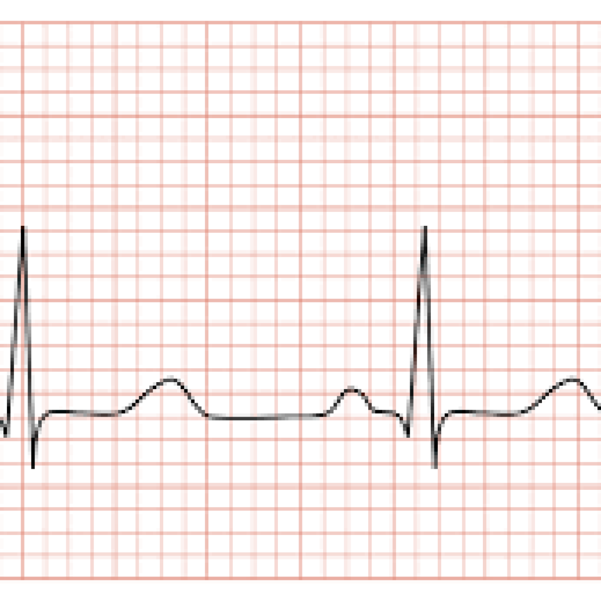 ecg1